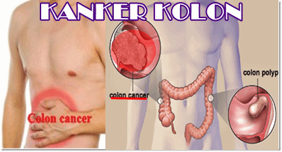 gejala kanker colorectal