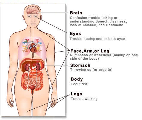 Cara Sederhana Menurunkan Risiko Stroke