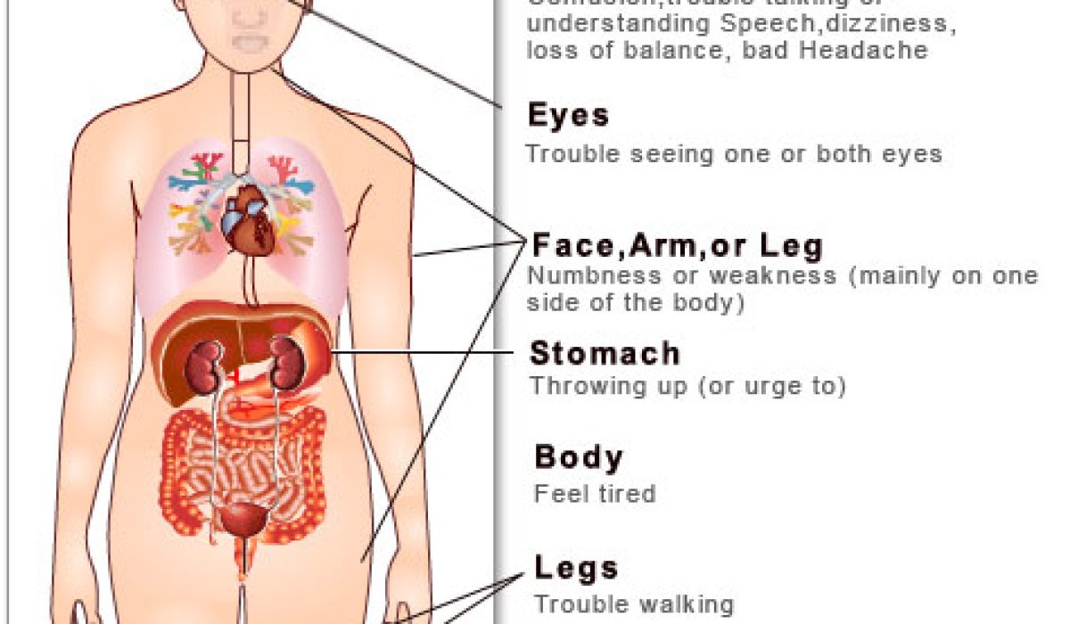 Cara Sederhana Menurunkan Risiko Stroke